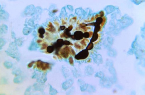 A deadly, drug-resistant fungus has arrived in the US