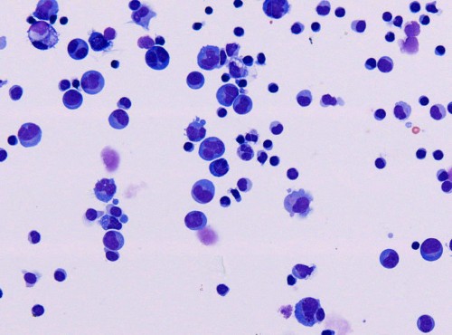 Biotech Stock Kite Pharma Explodes Higher After Good News About Its Non-Hodgkin Lymphoma Drug