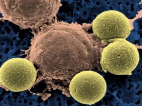 A new kind of drug is working better than chemotherapy in some lung cancer patients