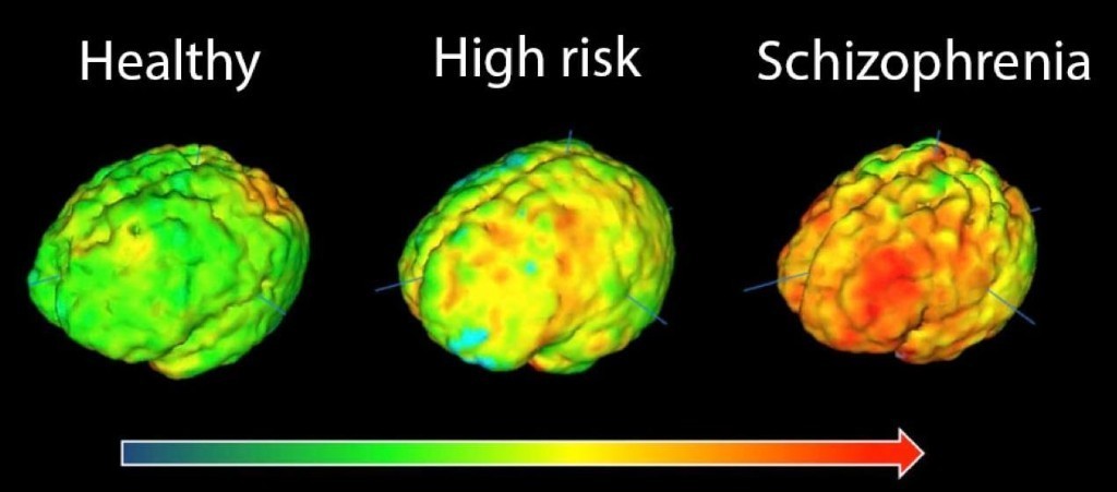 Radical new approach to schizophrenia treatment begins trial