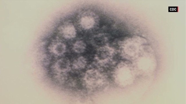 Enterovirus infections difficult to track
