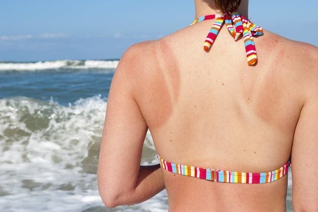 Here's What's Actually Happening To Your Body When You Get A Sunburn