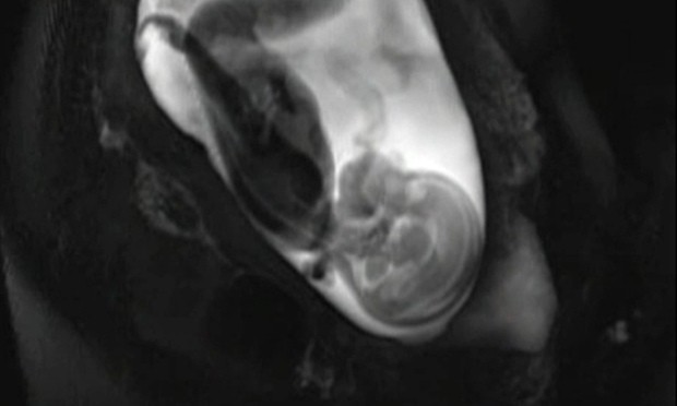 Prenatal blueprints give an early glimpse at a baby’s developing brain