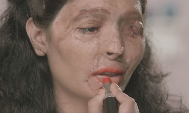 India is ignoring its growing acid attack crisis – but brave survivors are fighting back