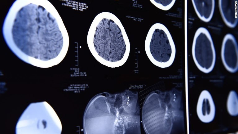 Brain scans could better predict your future