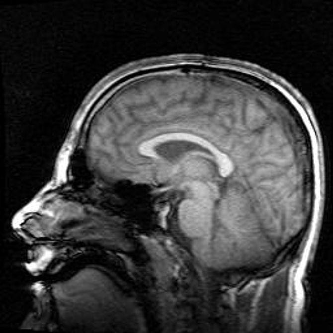 Can One Dose Of Antidepressant Lead To Changes In Your Brain?