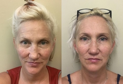 Face Yoga Is Super Weird, but It Actually Works