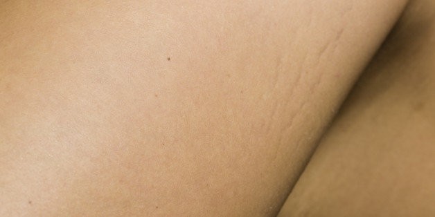Stretch Mark-Associated Genes Identified By Researchers