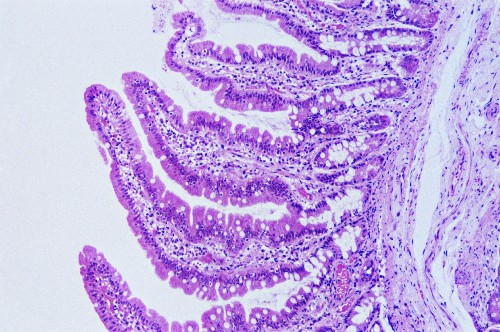 How's a Failed Cholera Vaccine Helping Millions of Children With Autism?