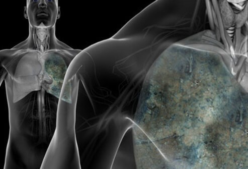 Using AI to Spot Lung Cancer