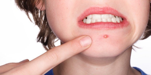 So, You Have A Pimple? Here's How To Get Rid Of It