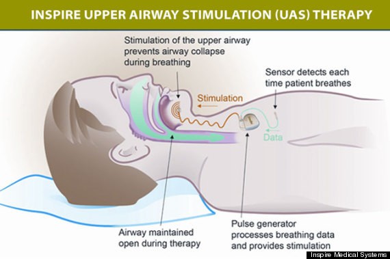 Mild Electronic Stimulation Therapy Effective For Sleep Apnea, Study Finds