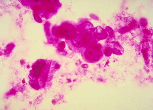 Cancer: More than just bad luck?