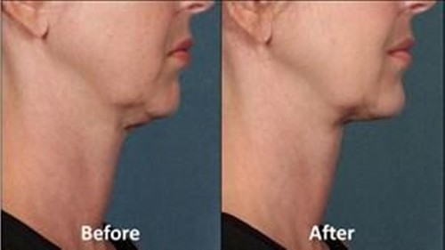 Too many chins? FDA clears a treatment for that
