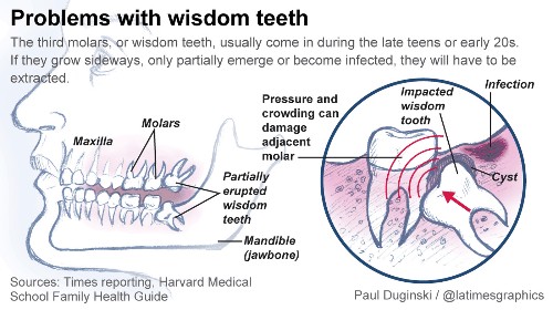 Dentists debate need to extract wisdom teeth