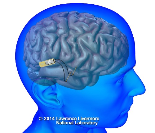 Pentagon spurs new work on a brain implant to aid memory problems - Los Angeles Times