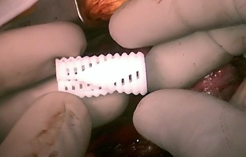 A 3-D-printed airway splint cures babies, then disappears - Los Angeles Times