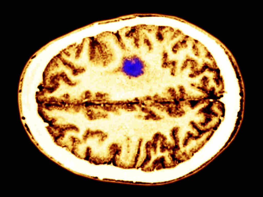 Thoughts Can Fuel Some Deadly Brain Cancers