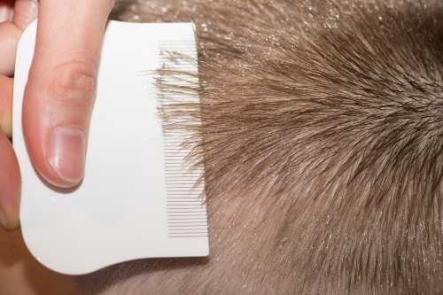 How to get rid of lice