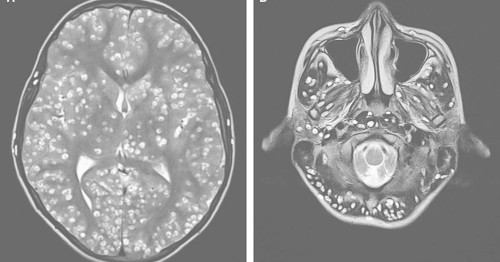 See what happens when tapeworms infest your brain