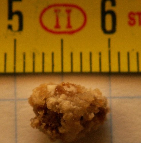Climate Change Likely To Lead To More Kidney Stones