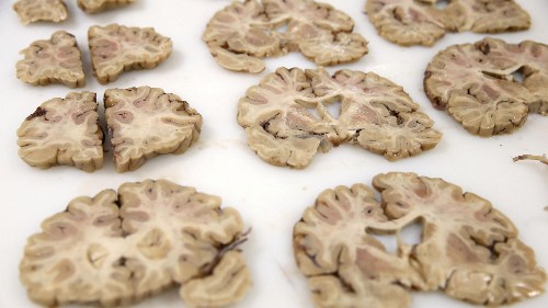 An organ once deemed “useless” may play a role in Parkinson’s disease