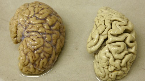 Why the pharmaceutical industry is giving up the search for an Alzheimer’s cure