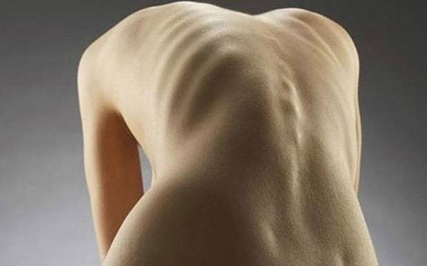 France makes glorifying anorexia online punishable by prison