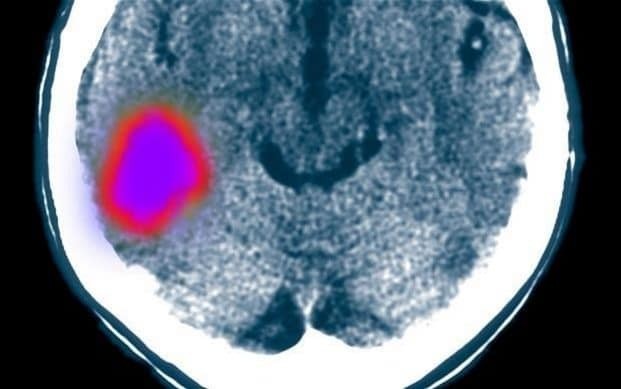 Stroke survivors walk again after Stanford injects stem cells into brain