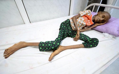 The West must get all sides in Yemen to reach a deal - or face an overwhelming humanitarian catastrophe