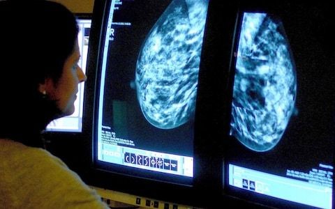 AI can diagnose breast cancer more accurately than a doctor can