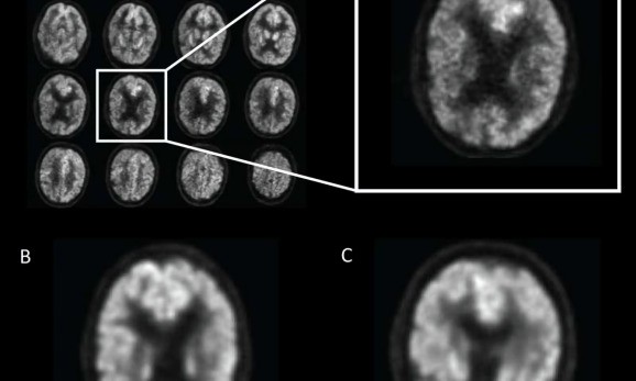 Computer vision identifies signs of early Alzheimer’s up to 6 years before clinical diagnosis